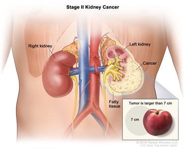 Stage II kidney cancer; drawing shows cancer in the left kidney and the tumor is larger than 7 centimeters. An inset shows 7 centimeters is about the size of a peach. Also shown are the fatty tissue and right kidney.