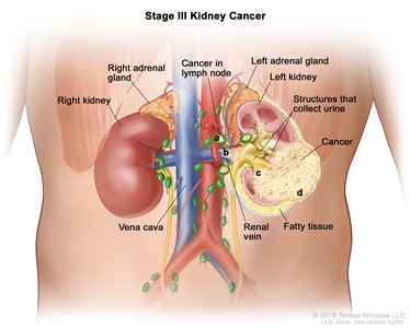 Stage III kidney cancer; drawing shows cancer in the left kidney and in a) nearby lymph nodes, b) the renal vein, c) the structures in the kidney that collect urine, and d) the layer of fatty tissue around the kidney. Also shown are the right kidney, vena cava, and right and left adrenal glands.