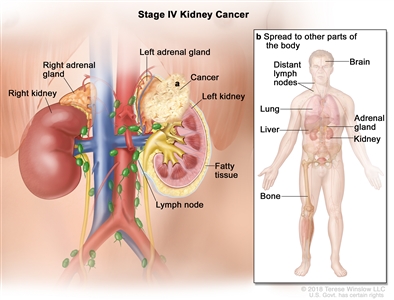 Stage IV kidney cancer; drawing shows cancer that has spread beyond the layer of fatty tissue around the left kidney to a) the adrenal gland above the left kidney. Also shown are the lymph nodes, right adrenal gland, and right kidney. An inset shows b) other parts of the body where kidney cancer may spread, including the brain, lung, liver, adrenal gland, bone, and distant lymph nodes.