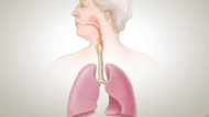 COPD: What Happens to Your Lungs