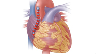 Bypass Surgery for Coronary Artery Disease