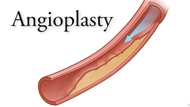 Angioplasty for Coronary Artery Disease