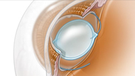  Cataract Surgery