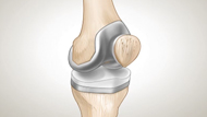 Knee Replacement Surgery