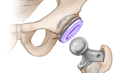 Hip Replacement Surgery