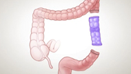 Bowel Resection