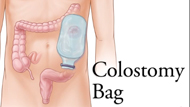 Colostomy