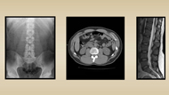 Tests for Low Back Pain