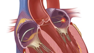 Catheter Ablation for Atrial Fibrillation