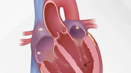 What Is Atrial Fibrillation?