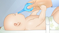  Using a Rubber Bulb to Clear a Baby's Nose