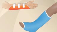  Taking Care of a Cast or Splint