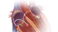 Catheter Ablation for SVT