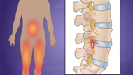 Back Surgery for Herniated Disc