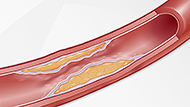 Cholesterol: How It Raises Your Risk 