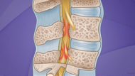 Back Surgery for Spinal Stenosis