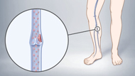  Preventing Blood Clots in Leg Veins