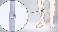  What Is Deep Vein Thrombosis (DVT)?