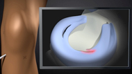  Meniscus Surgery 