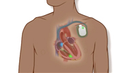  Arrhythmia: What Is an ICD?