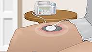 Negative Pressure Wound Therapy