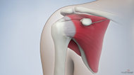 Rotator Cuff Surgery 