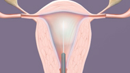 Endometrial Ablation