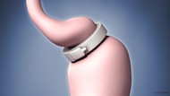  Laparoscopic Gastric Banding