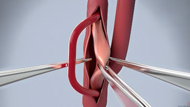  Carotid Endarterectomy 