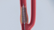  Carotid Artery Stenting 