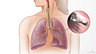 Bronchoscopy