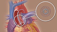  Transcatheter Aortic Valve Replacement (TAVR) 