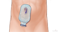  Ileostomy