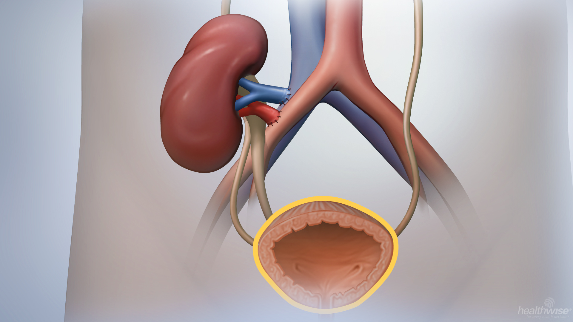 Kidney Transplant: Before Your Surgery