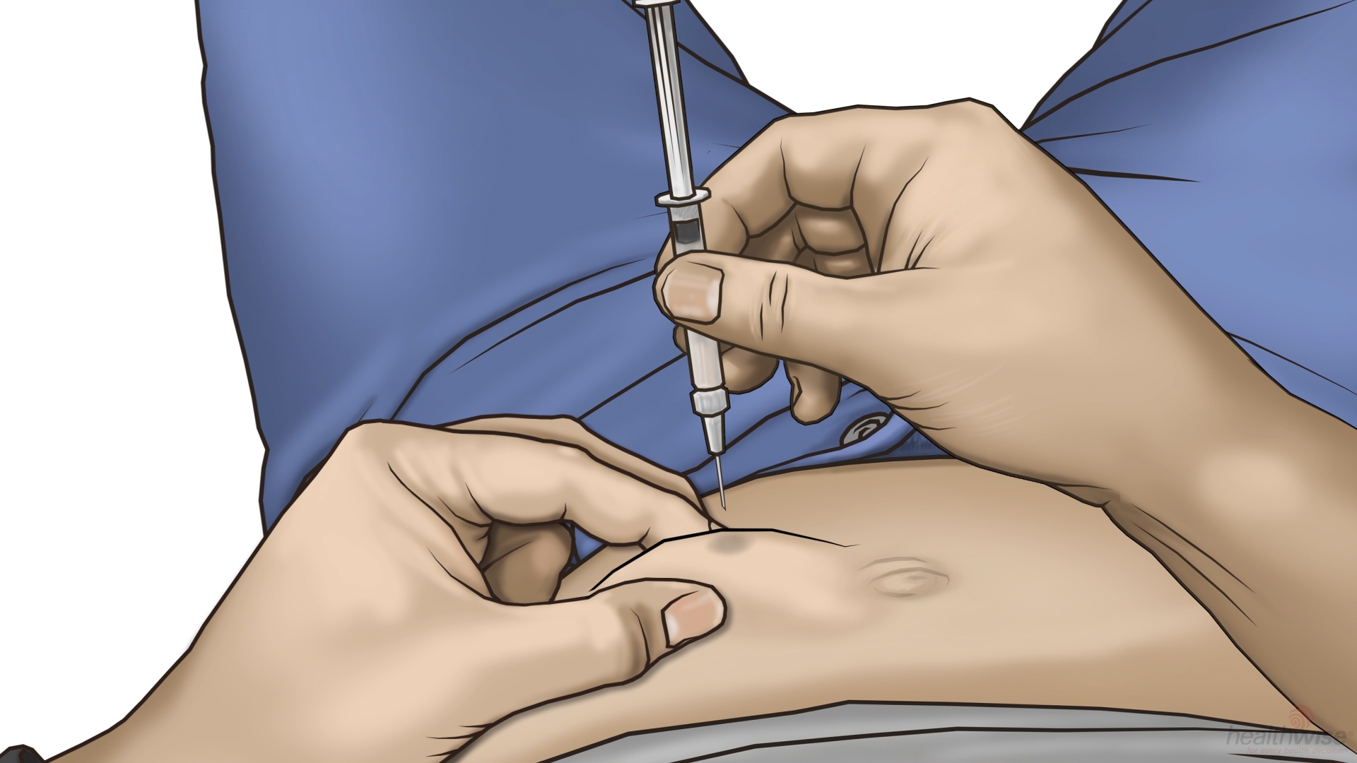 How to Give a Subcutaneous Injection 