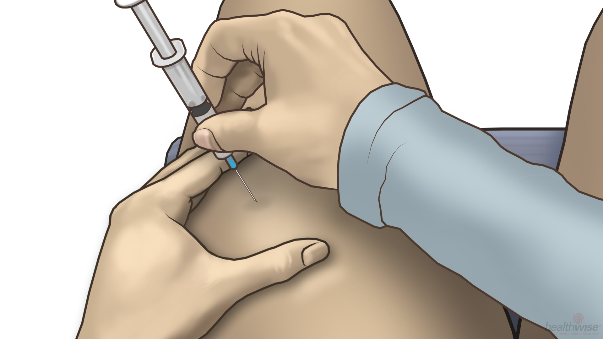 How to Give an Intramuscular Injection 
